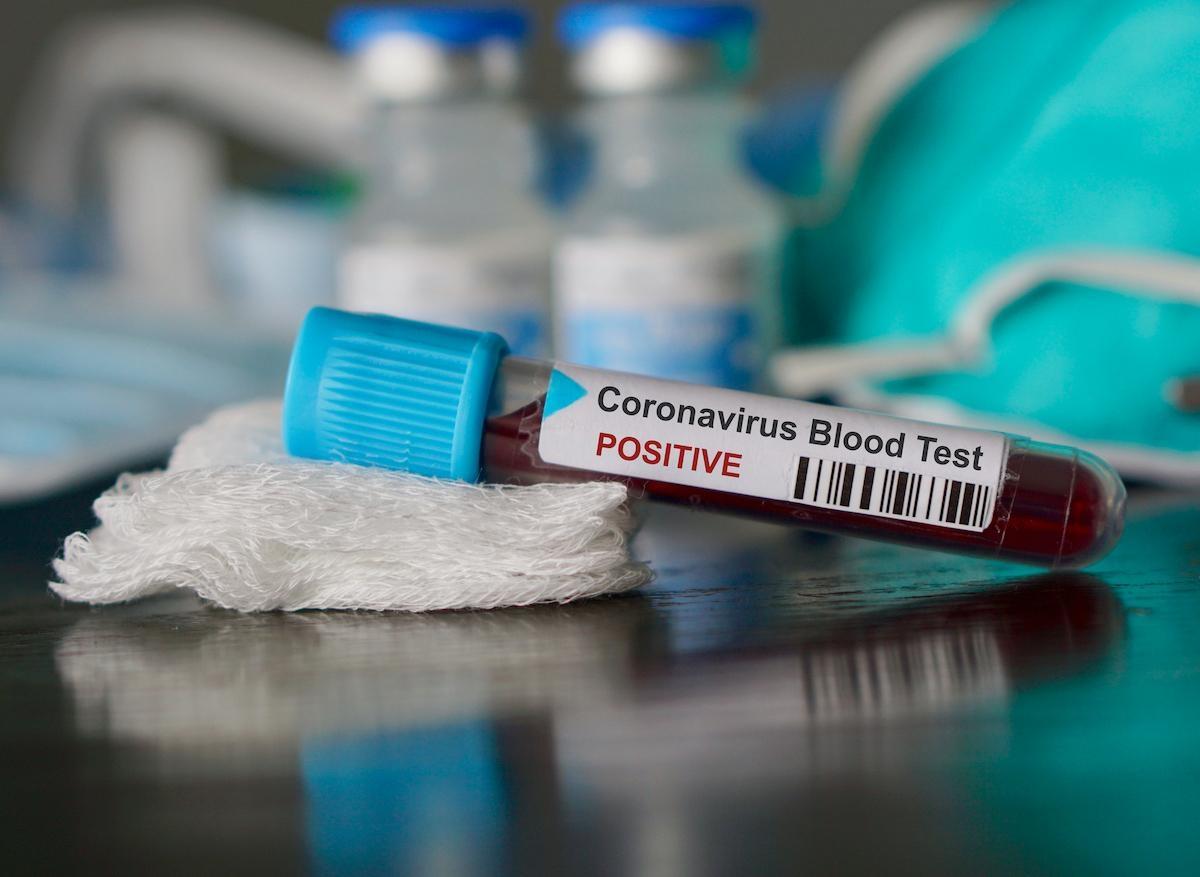 Coronavirus : le gouvernement veut multiplier les tests pour dépister