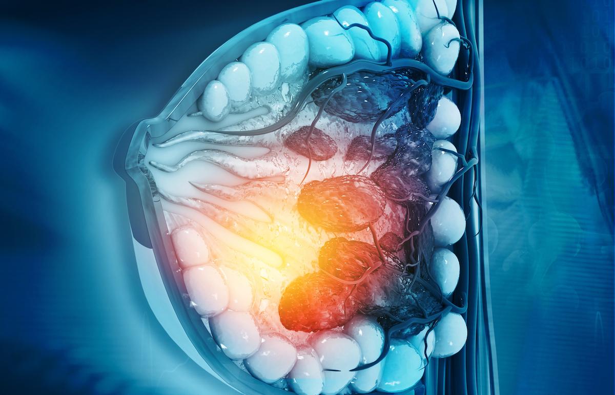 Cancer du sein métastatique HER2+ : une place pour le trastuzumab haute dose ?