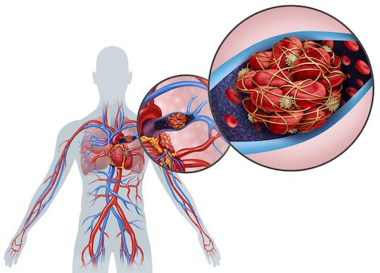 Covid-19 et poumon : fréquence particulière de l’atteinte vasculaire et thrombotique