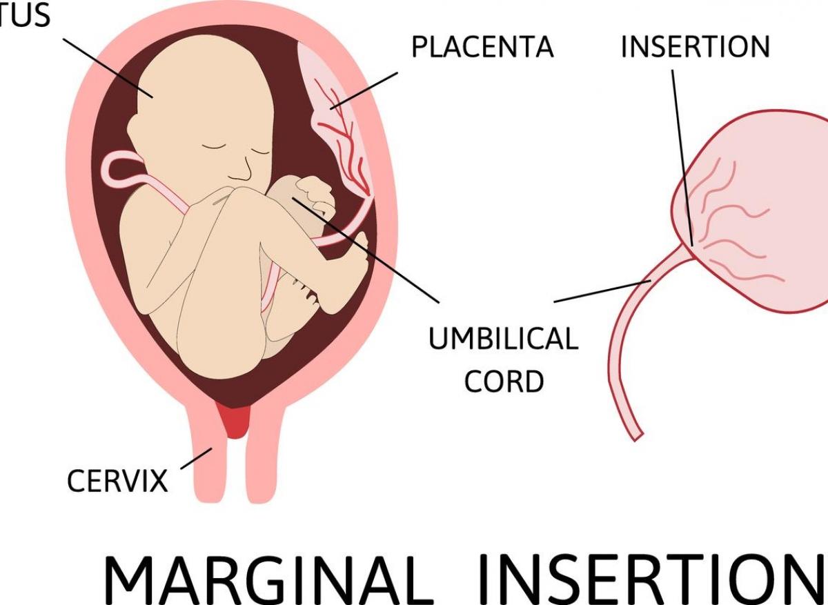 Formes sévères de la Covid-19 : effet très prometteur des cellules souches de sang de cordon