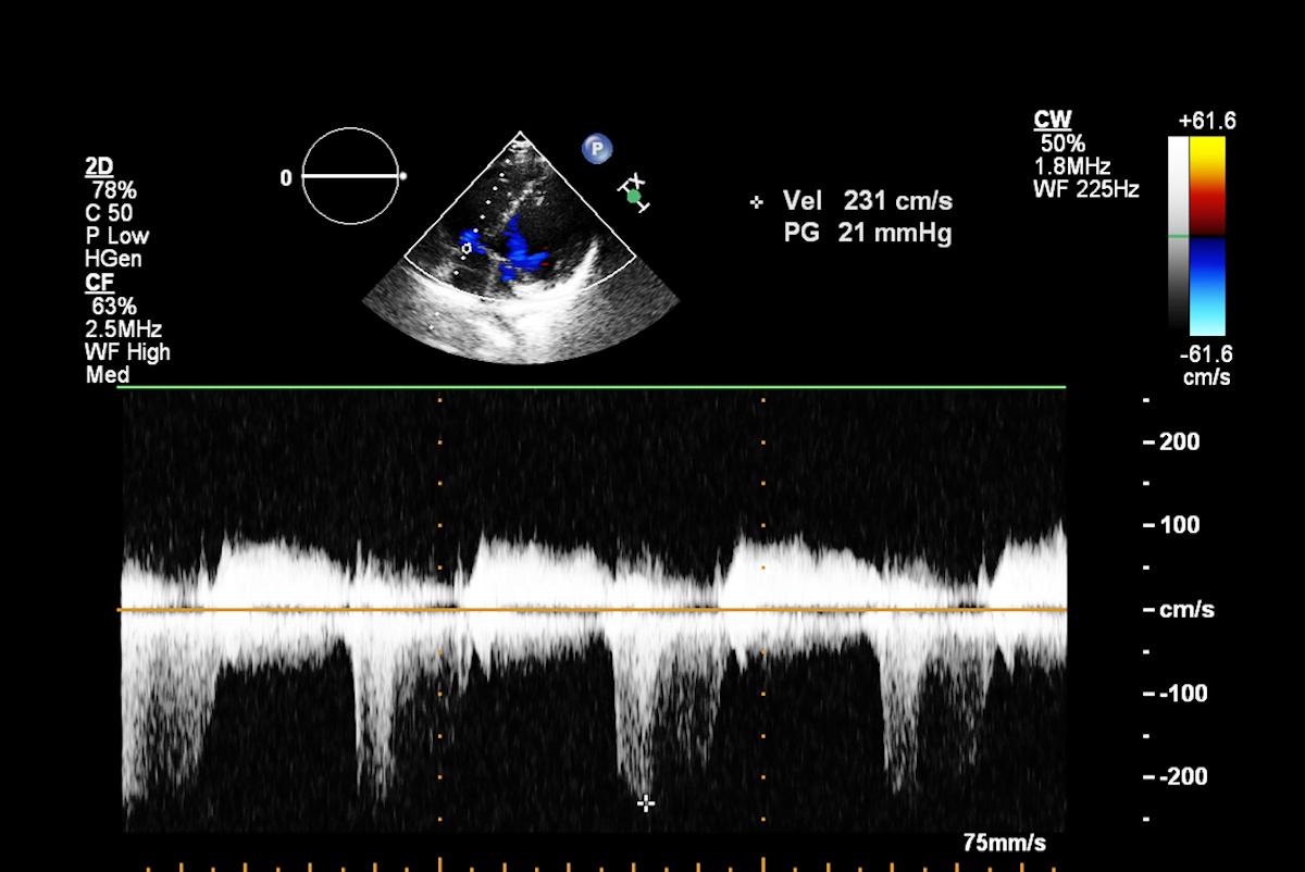 Insuffisance cardiaque : sténose coronaire et dysfonction microvasculaire fréquentes en cas de fraction d’éjection préservée