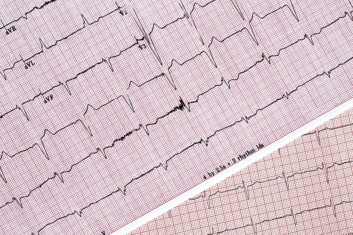 Fibrillation atriale : la dépister et la traiter, oui, mais laquelle ?