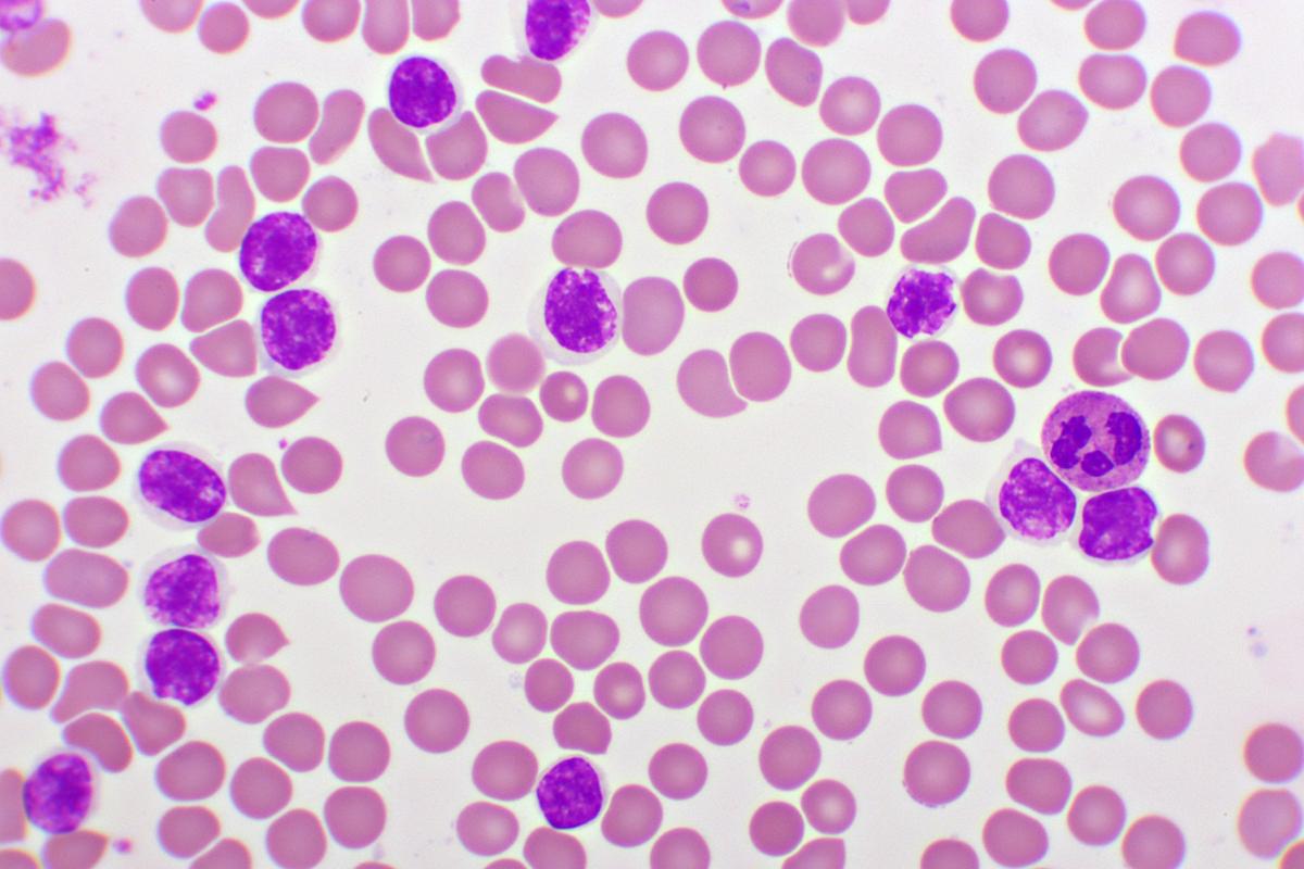 Leucémie lymphoïde chronique : 2 malades guéris à 10 ans d’un traitement par CAR-T cells