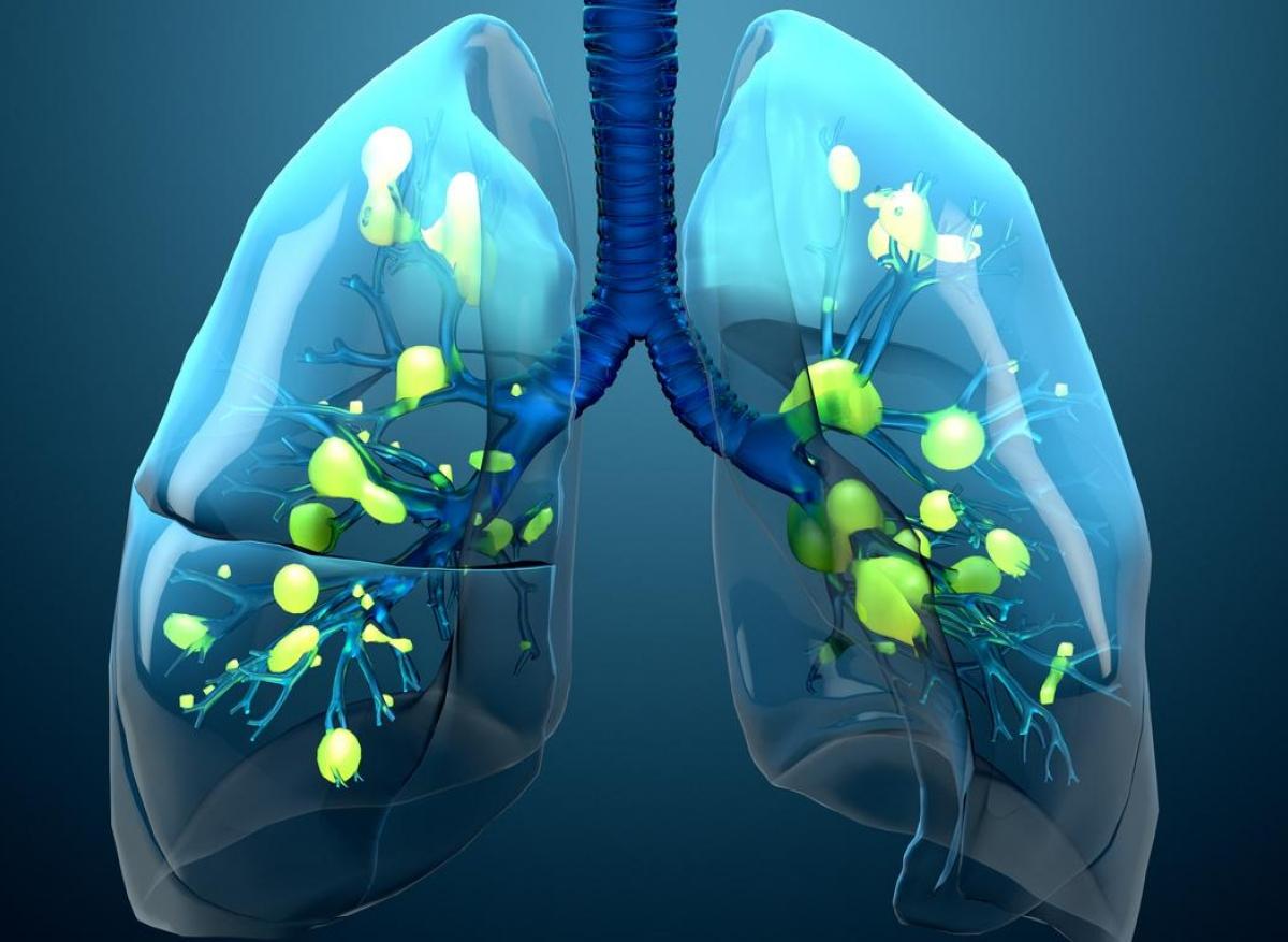 Infections pulmonaires : l'IL-33 serait responsable des séquelles à long terme