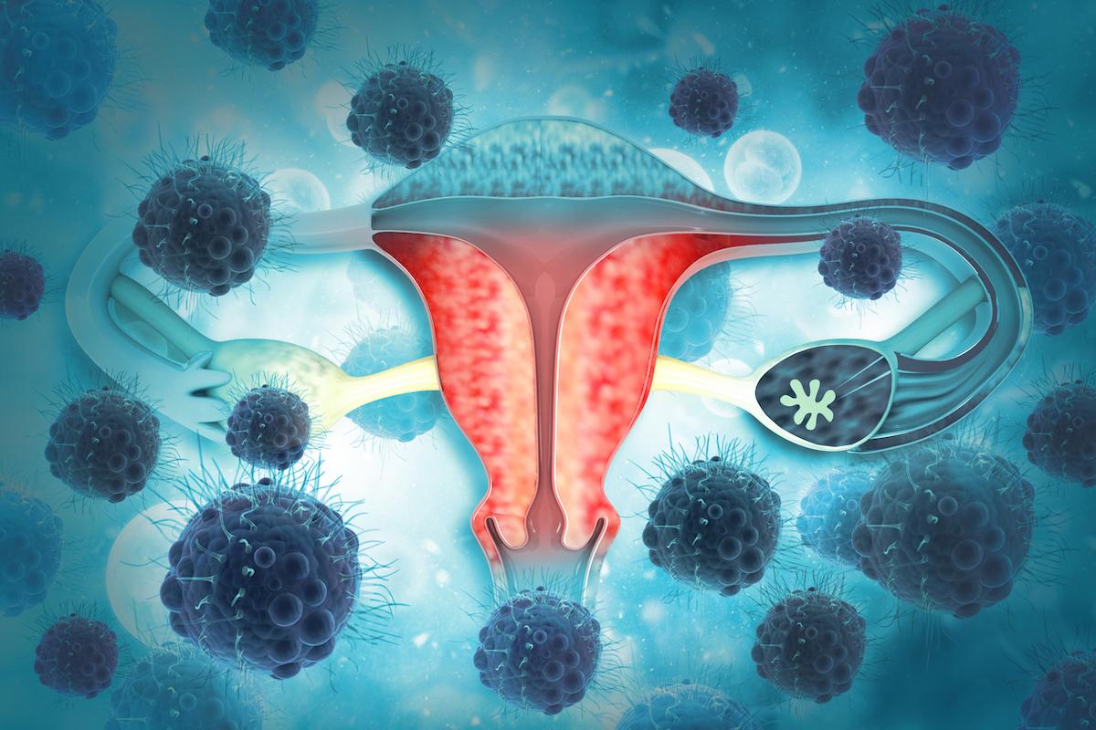 Cancer de l'ovaire en récidive : faut-il réopérer les patientes ?