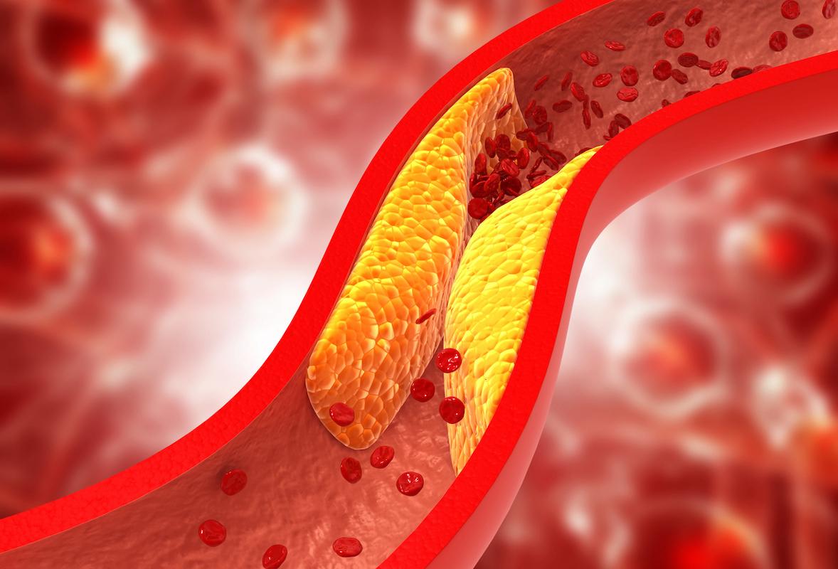 AOMI et plaques calcifiées : supériorité de la lithotritie endovasculaire 