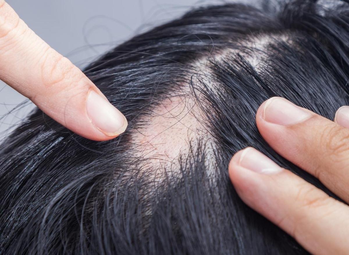 Pelade : un nouveau traitement favoriserait la repousse des cheveux