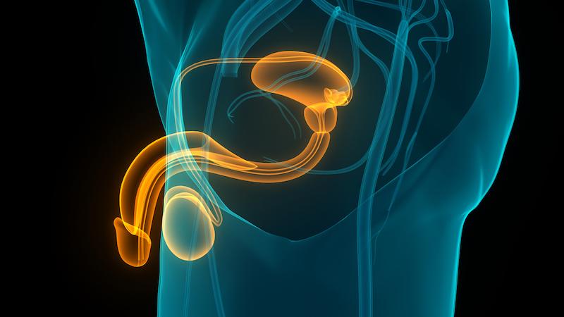 Néoplasies intra-épithéliales du pénis : deux voies physiopathologiques sont parfois associées.