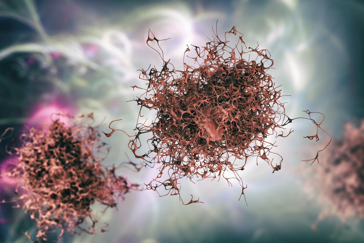 Myélome en rechute : les très bons résultats d’un CAR-T cell anti-BCMA