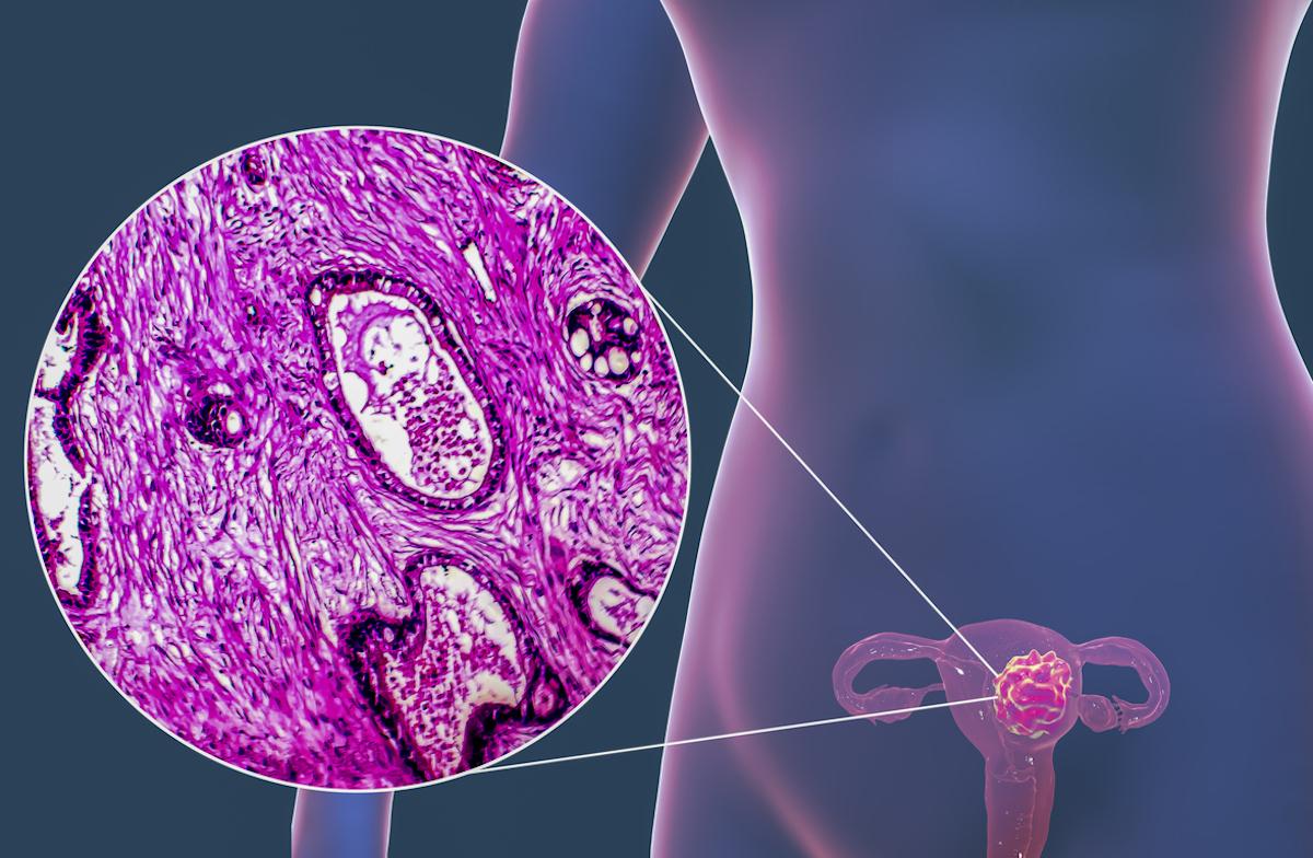 Cancer de l’endomètre : la place de l’immunothérapie reste à mieux définir