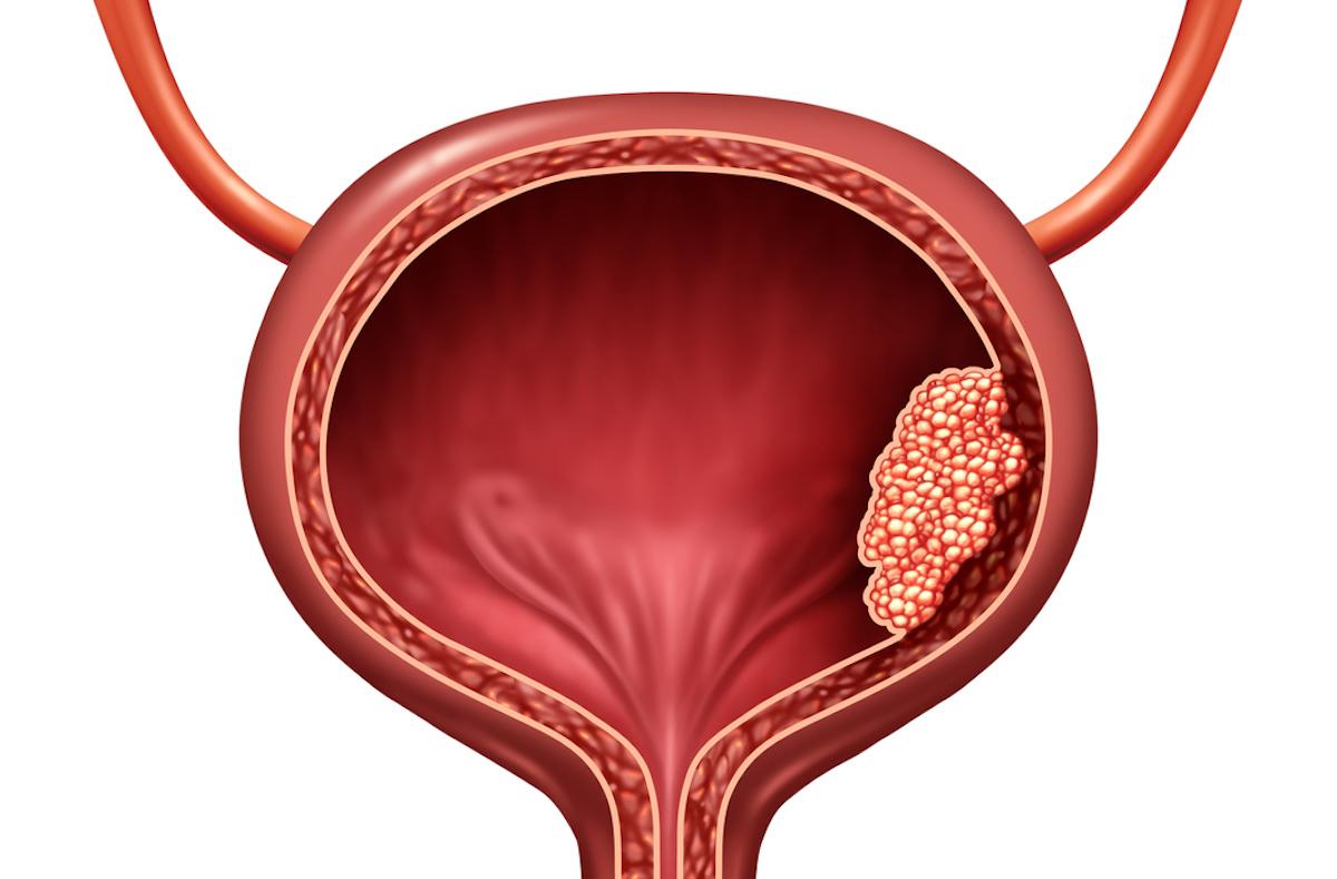 Cancer de la vessie : intérêt d’une association nintedanib + chimiothérapie en néoadjuvant