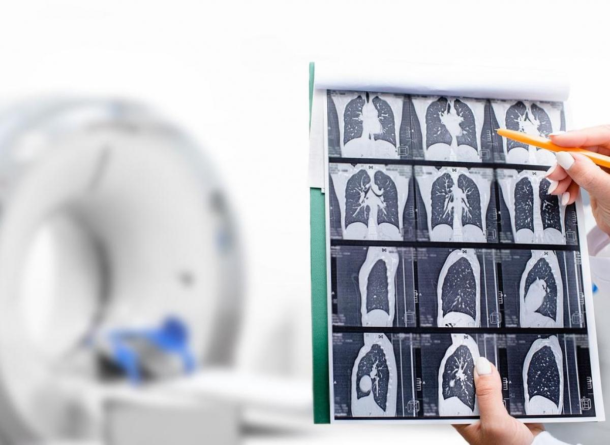 Cancer du poumon : aller plus loin dans le dépistage