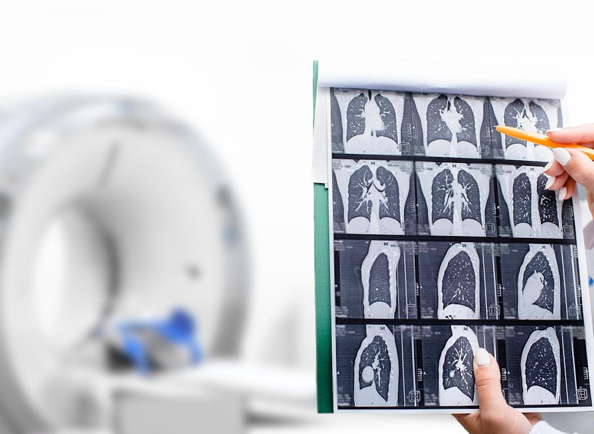 Cancer du poumon : le dépistage précoce augmente les chances de survie