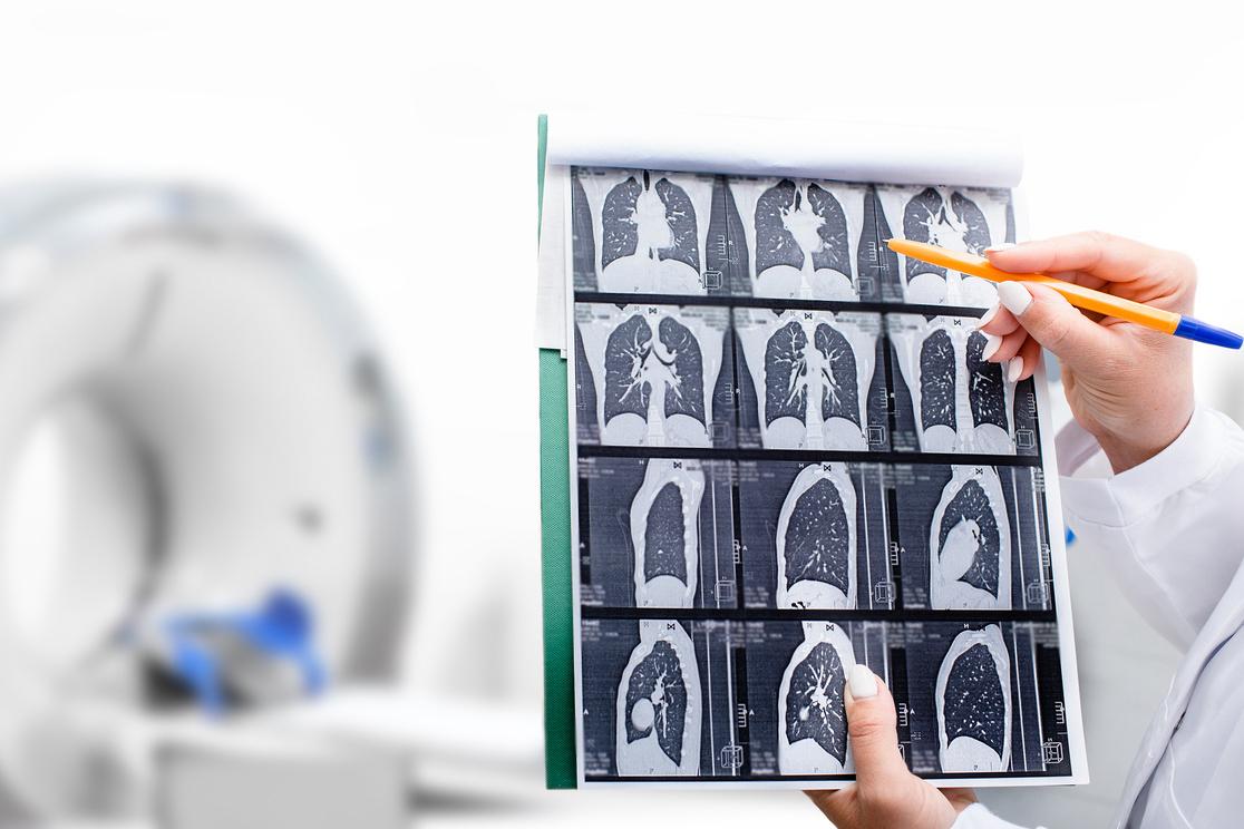 Cancer pulmonaire : le scanner thoracique permettrait un dépistage plus précoce