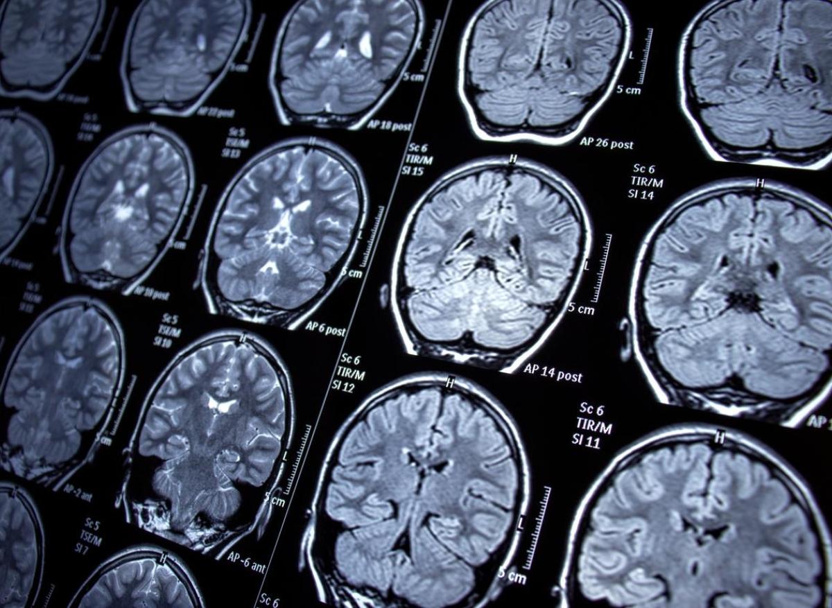 Réseaux neuronaux : un réseau cérébral commun à six maladies psychiatriques