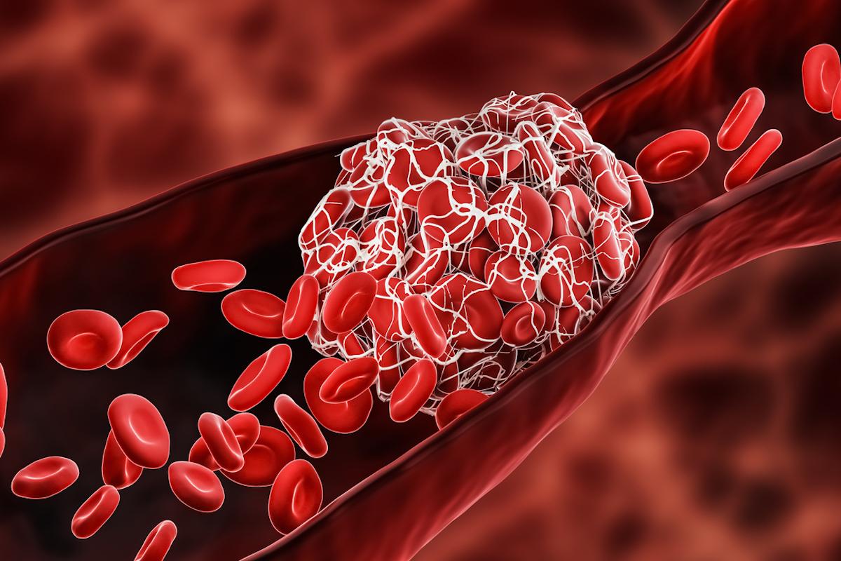 Covid-19 et prévention des thromboses : la dose anticoagulante dépend de la sévérité