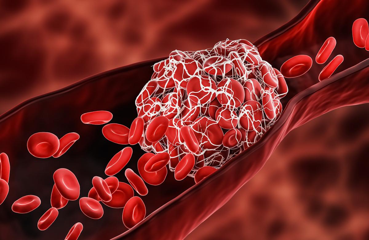 Thrombose veineuse profonde : peu de différences entre anticoagulants directs 