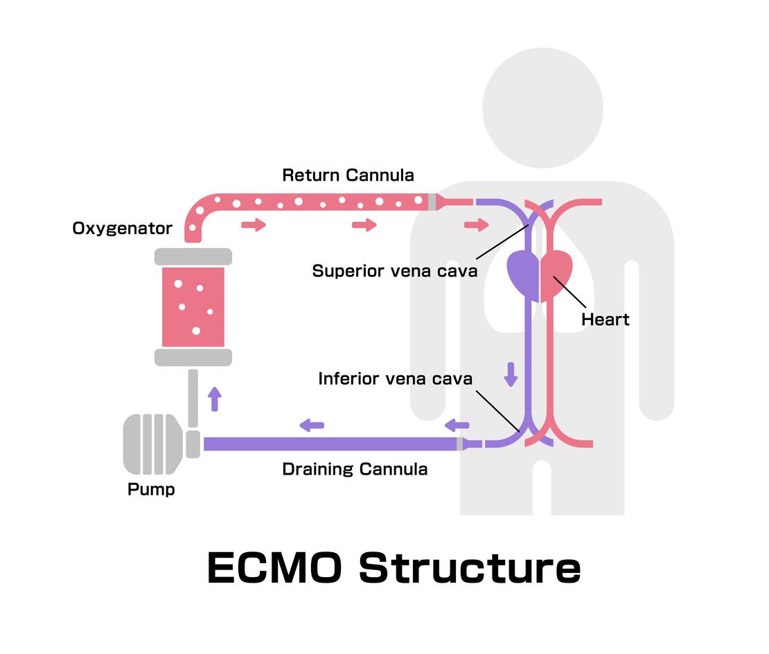 Détresse respiratoire aiguë et ECMO-VV : position dorsale ou position ventrale ?