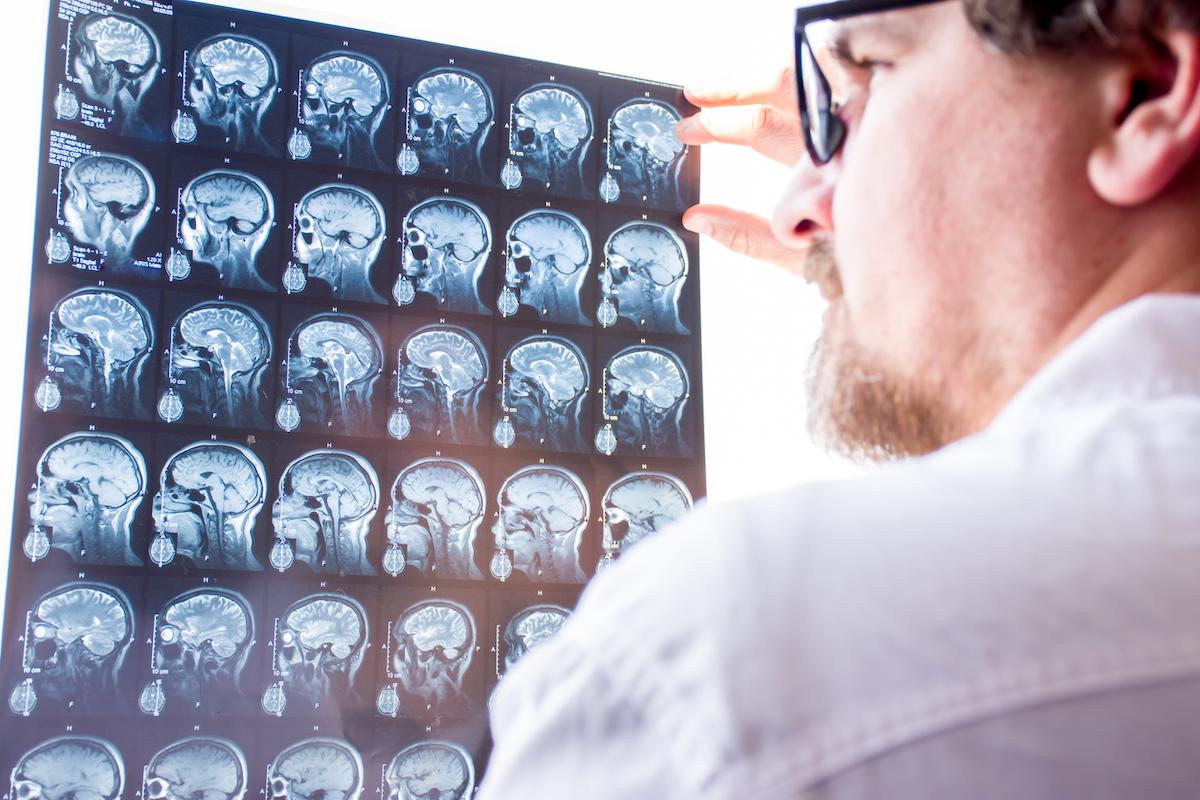 IRM cérébrale : diagnostic d’une lésion inflammatoire de grande taille ?