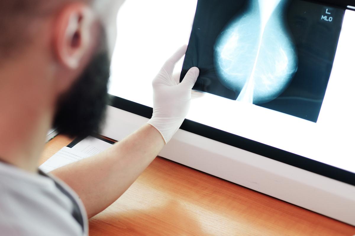 Mammographie 3D : un bénéfice chez les femmes à haut risque et seins denses