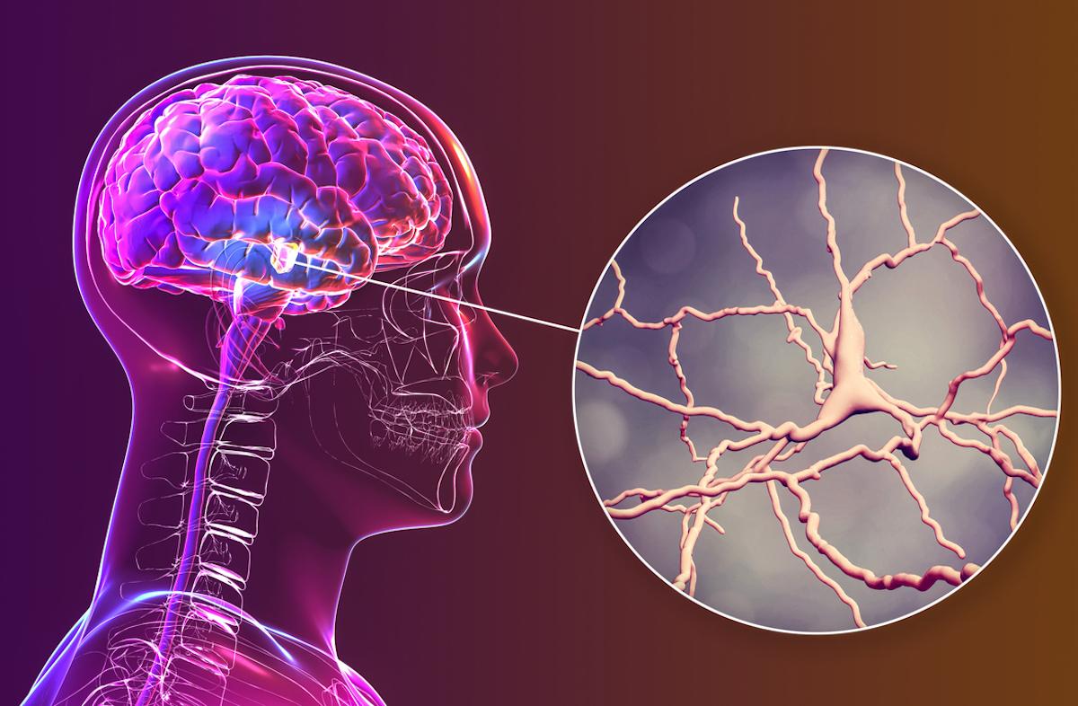 Parkinson : efficacité du traitement par ultrasons focalisés sur le globus pallidus