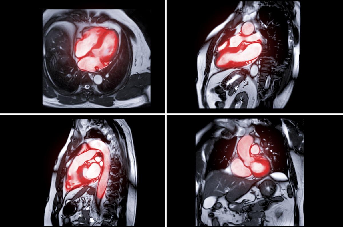 Rétrécissement aortique et TAVI : bons résultats à un an chez les patients à risque modéré