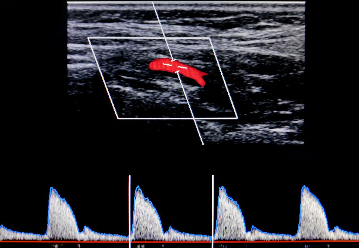 Sténose carotidienne serrée asymptomatique : endartériectomie et stenting font jeu égal