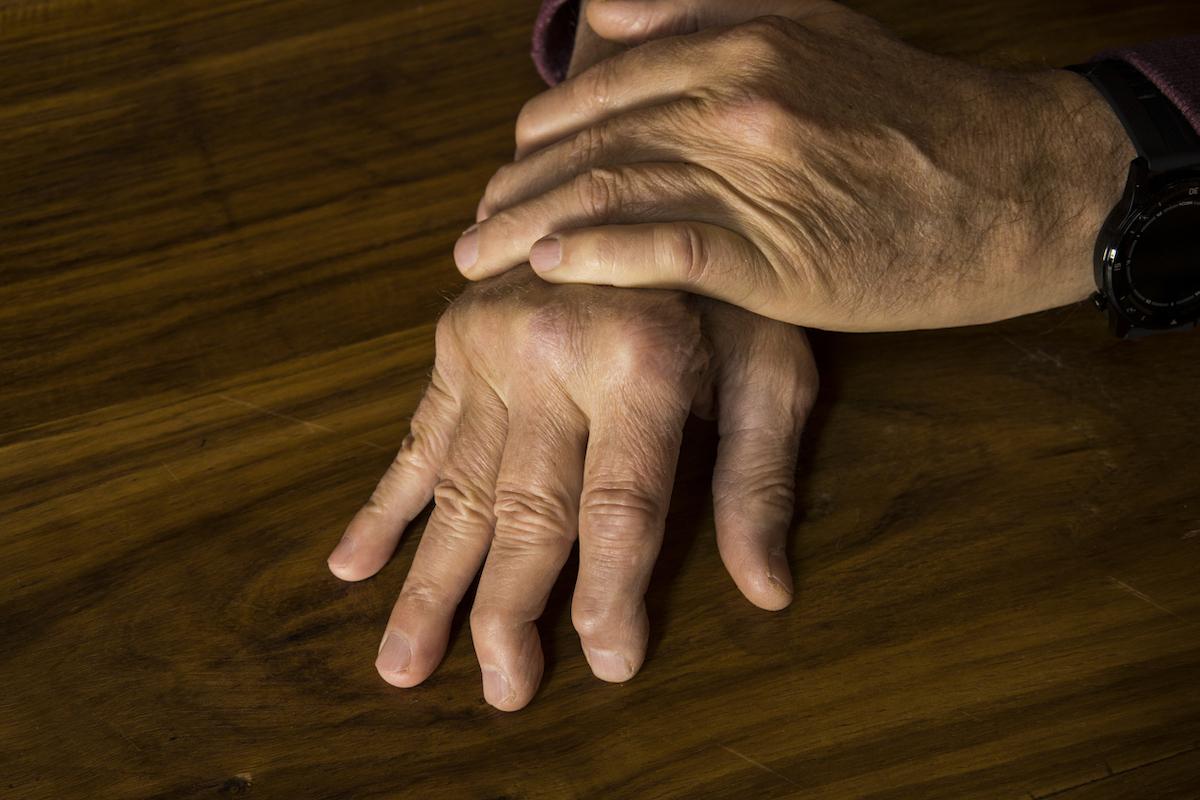 Arthrose des doigts : pas d’intérêt démontré de la colchicine sur la douleur