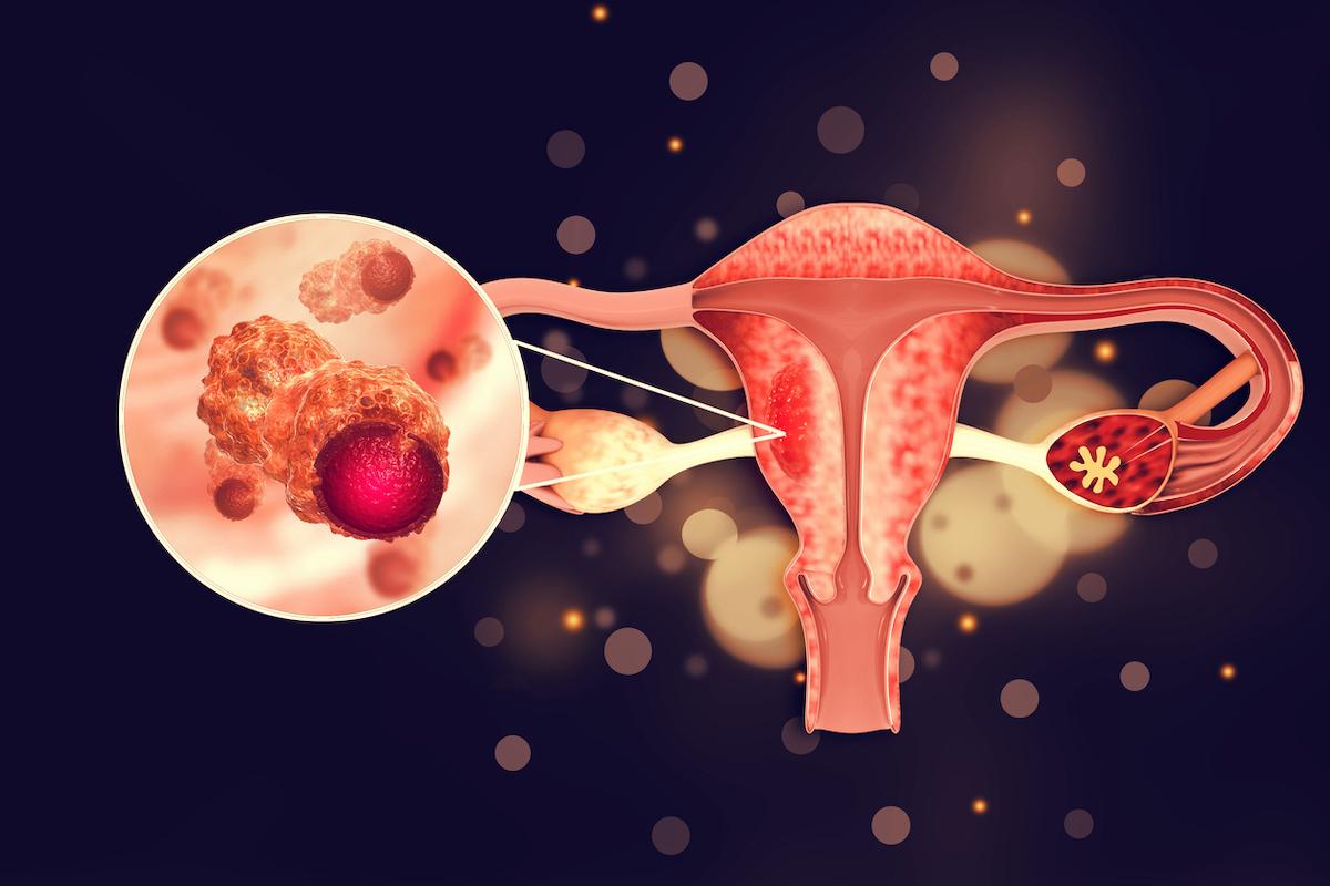 Cancer de l’endomètre : hormonothérapie seule ou en association ?