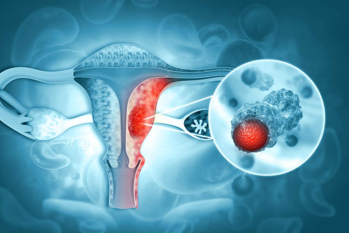 Cancer de l’ovaire : une alternative aux sels de platine ? 