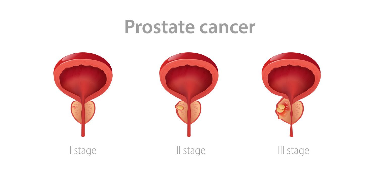 Cancer de la prostate : la testostérone restaurerait la libido sans risque pour le patient