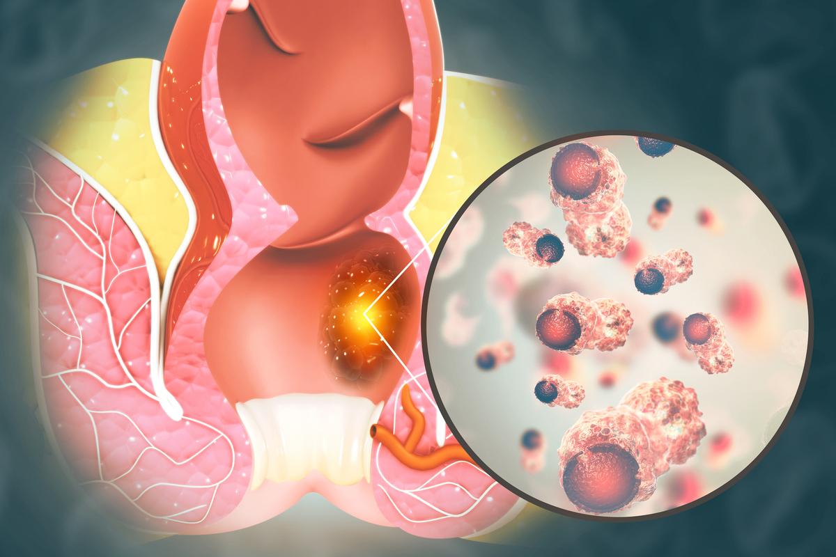 Cancer canal anal non métastatique : la cohorte FFCD-ANABASE fait ses preuves