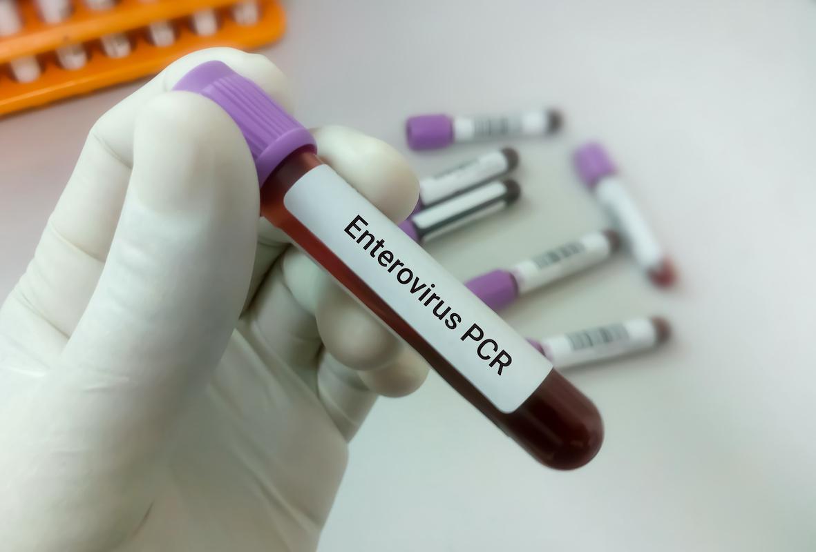 Entérovirus D68 : craintes d’une épidémie à risque de myélite cet automne