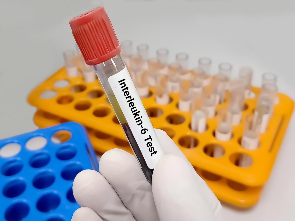 Blocage des ICI : l’inhibition de l’IL-6 comme stratégie intéressante