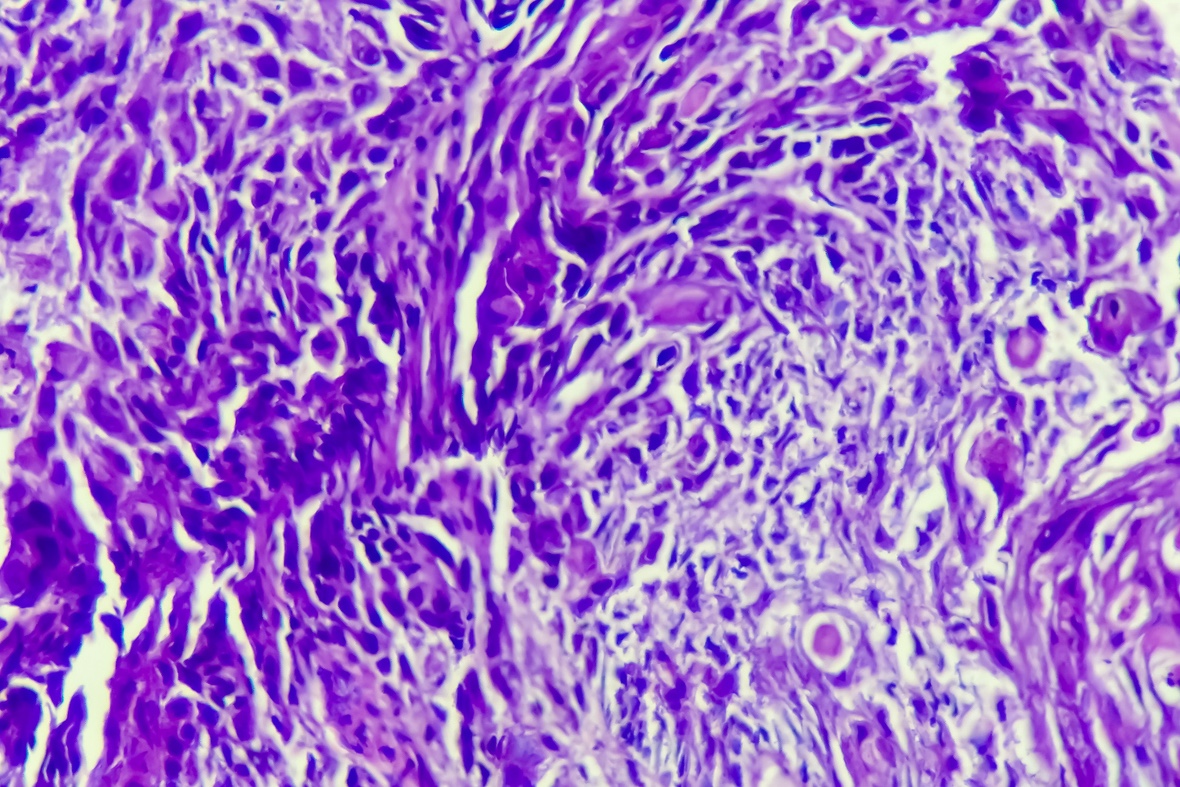 Adénocarcinomes de l’oesophage : plutôt FLOT que CROSS