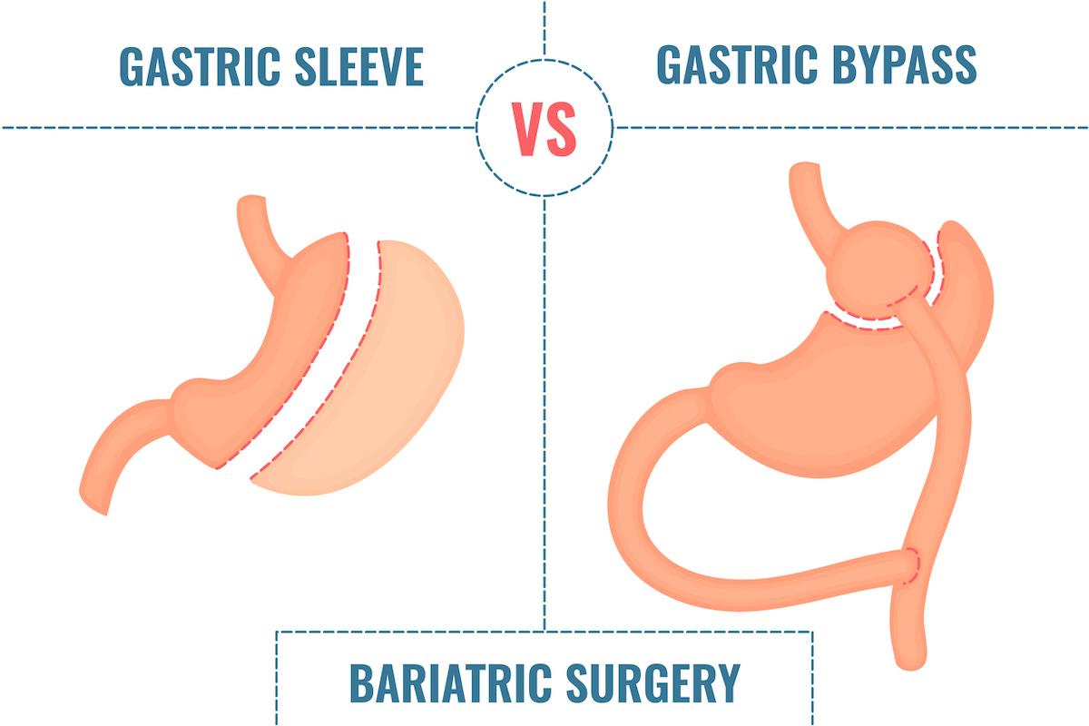 Diabète de type 2 : la chirurgie bariatrique meilleure sur le long terme