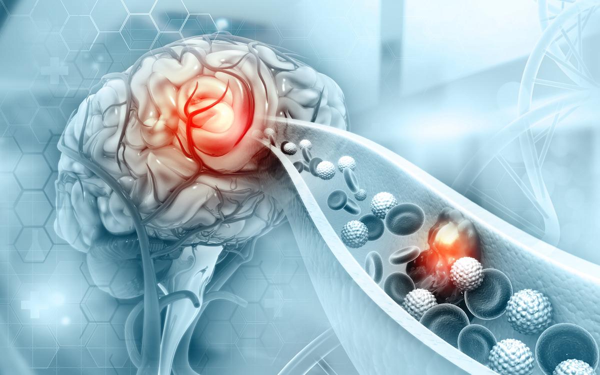 AVC ischémique à la phase aiguë : une pression artérielle systolique à 120 mm Hg est néfaste