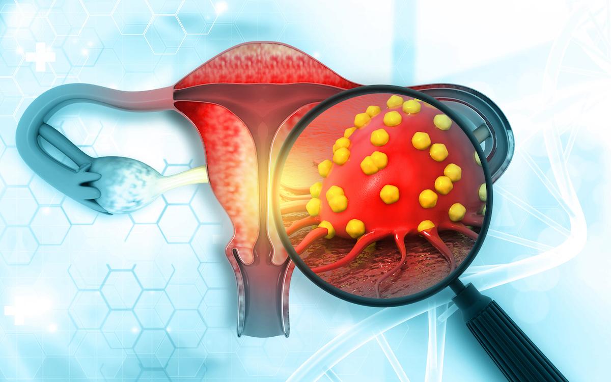 Cancer de l’endomètre avancé RE+ : intérêt des inhibiteurs de CDK4/6 