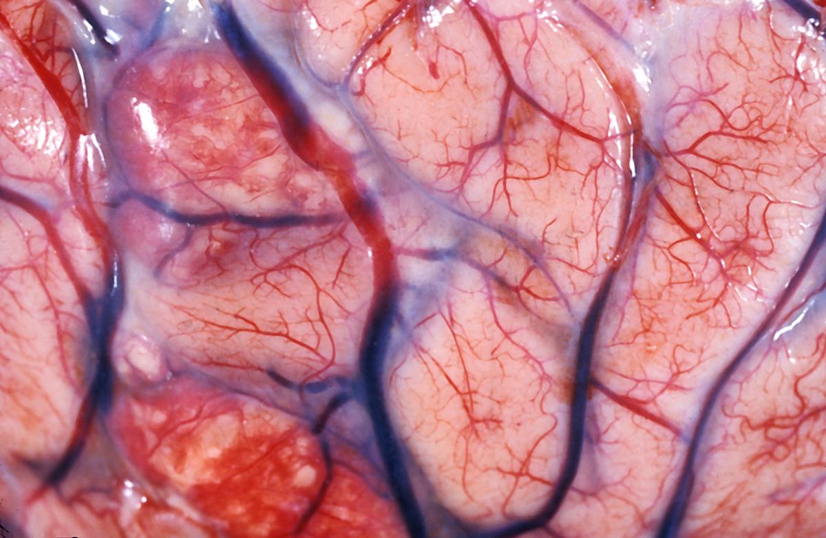 Lymphome B diffus à grandes cellules : pas de bénéfice à la prophylaxie neuroméningée par MTX IV