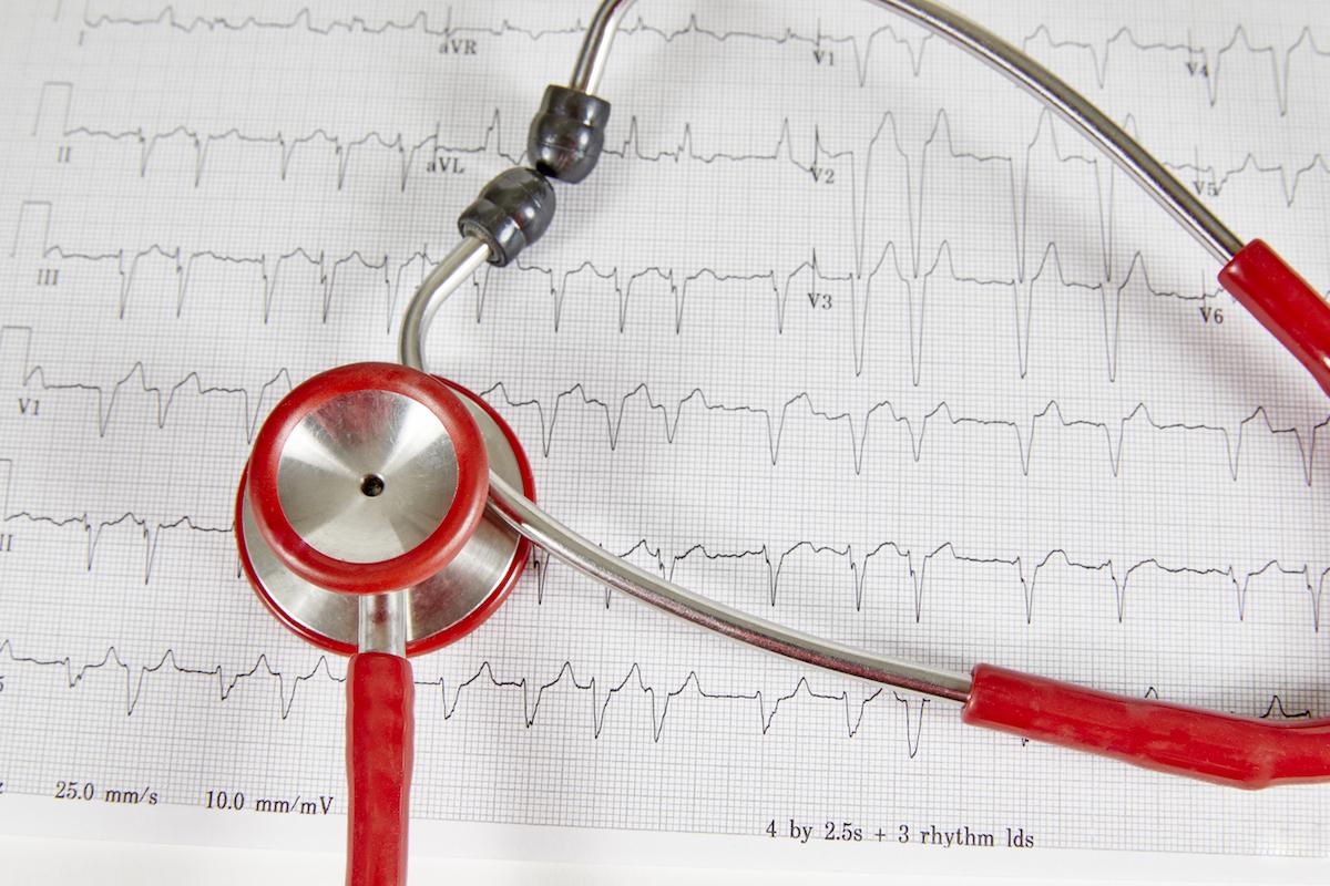 Fibrillation atriale : l'insuffisance cardiaque est la complication la plus fréquente