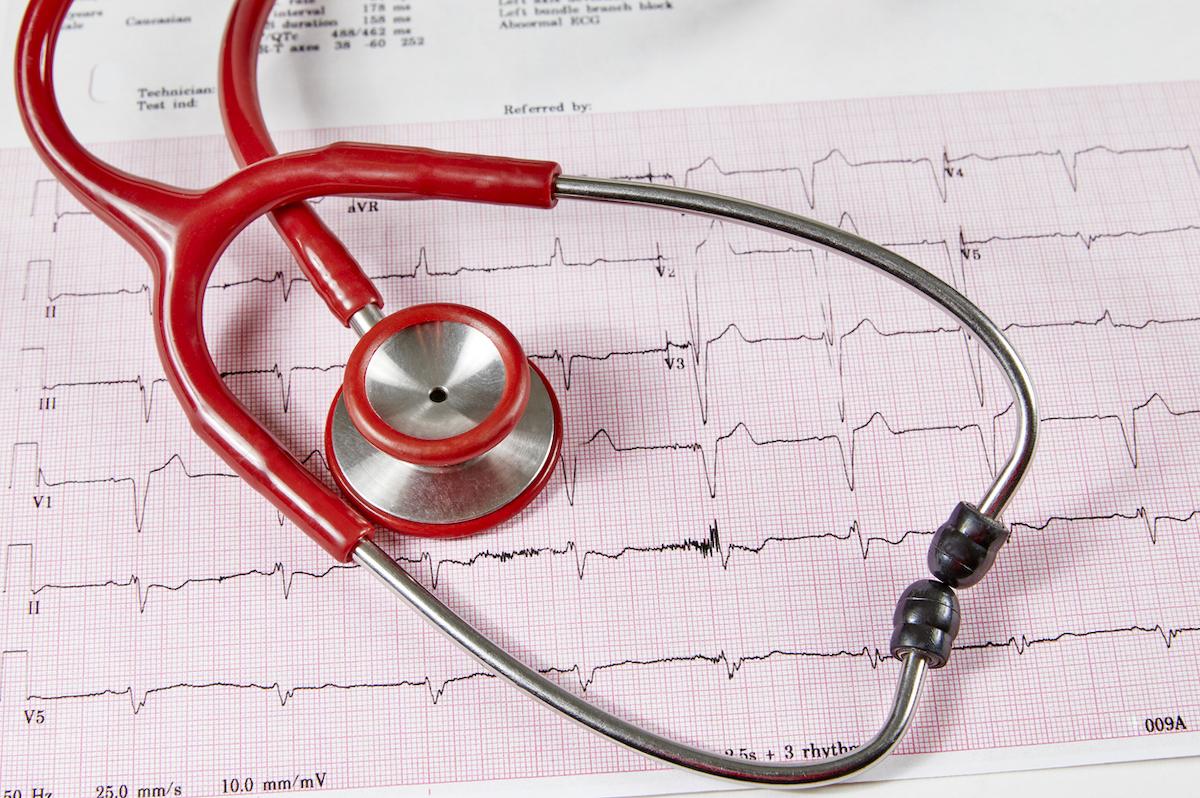 Fibrillation atriale : lesquelles peut-on ne pas anticoaguler ?