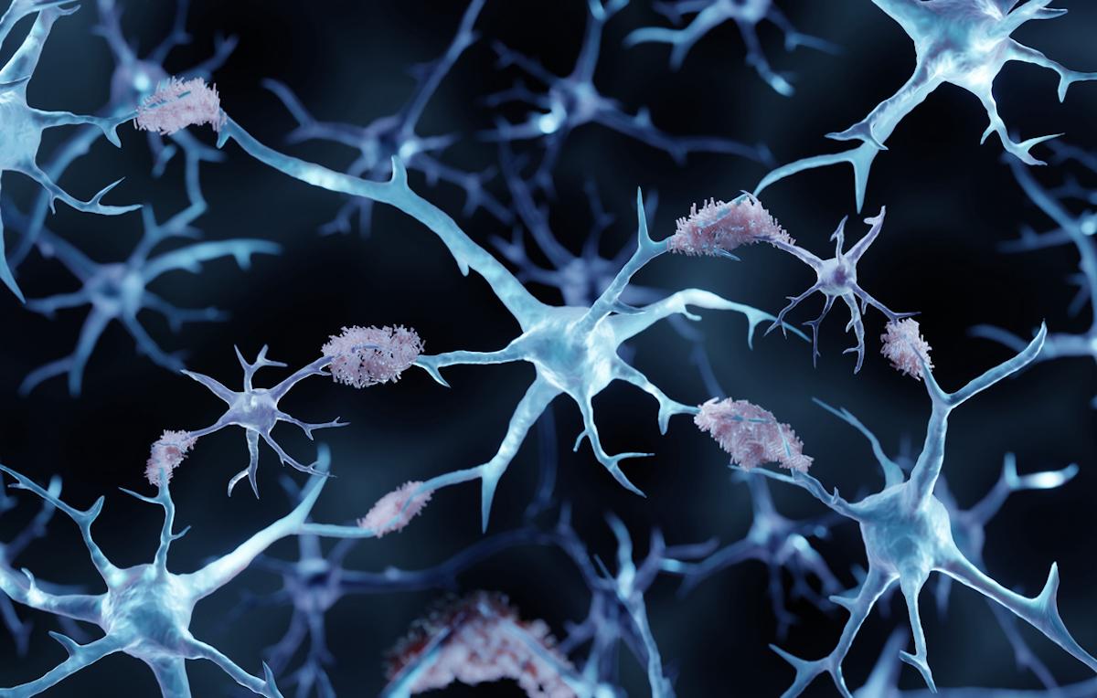 Maladie d’Alzheimer : intérêt confirmé des anti-amyloïdes à un stade plus précoce