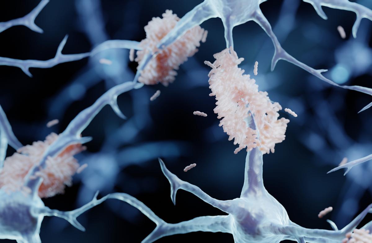 Maladie d’Alzheimer : nouvel échec d’un anticorps anti-amyloïde en prévention