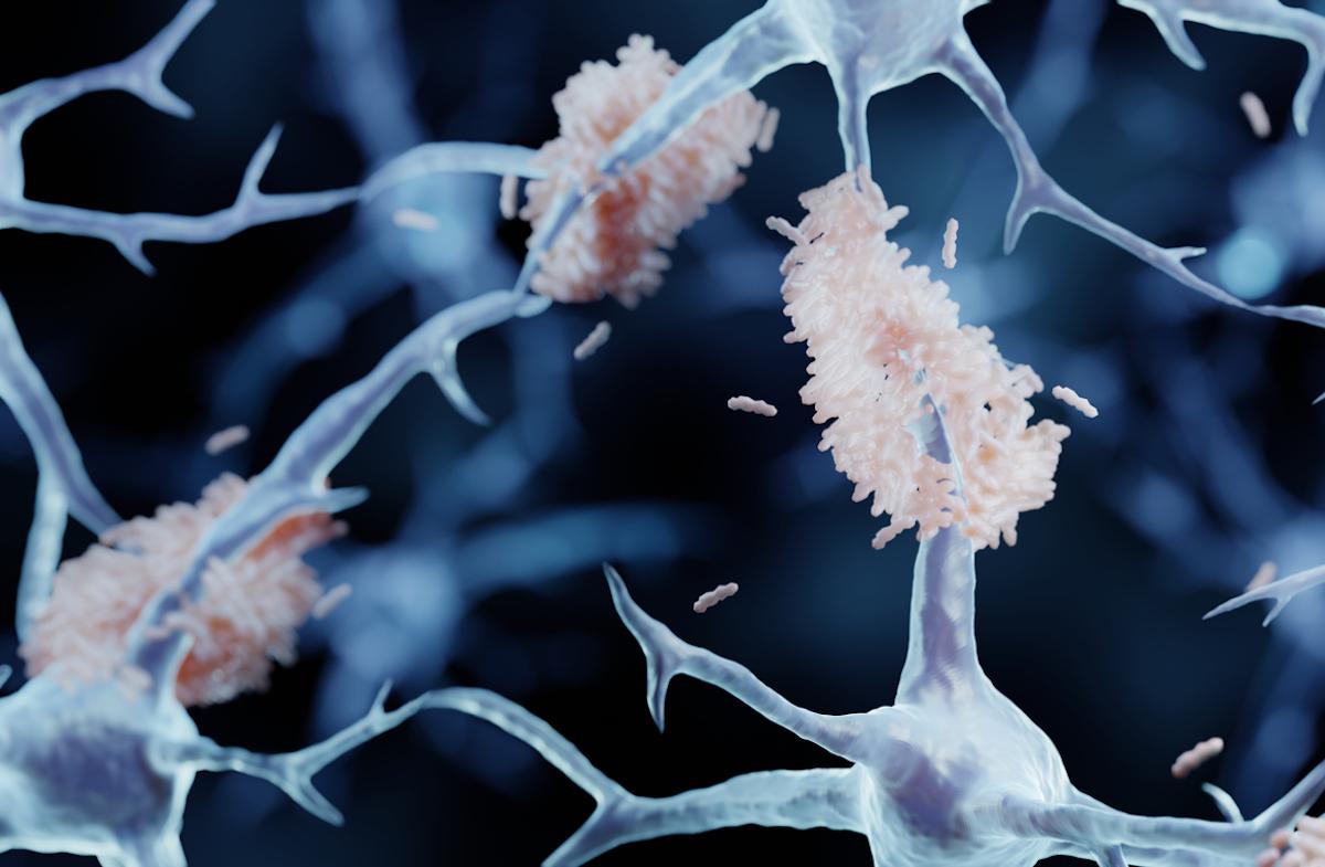 Alzheimer : un anti-amyloïde prometteur au stade précoce mais pas sans effets secondaires