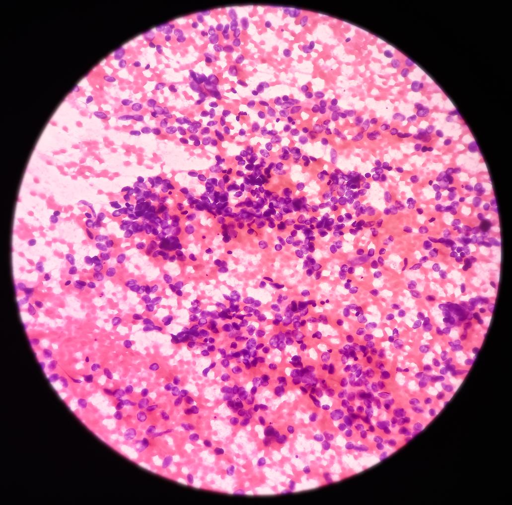 Cancer bronchique à petites cellules étendu : une nouvelle association améliore la survie 