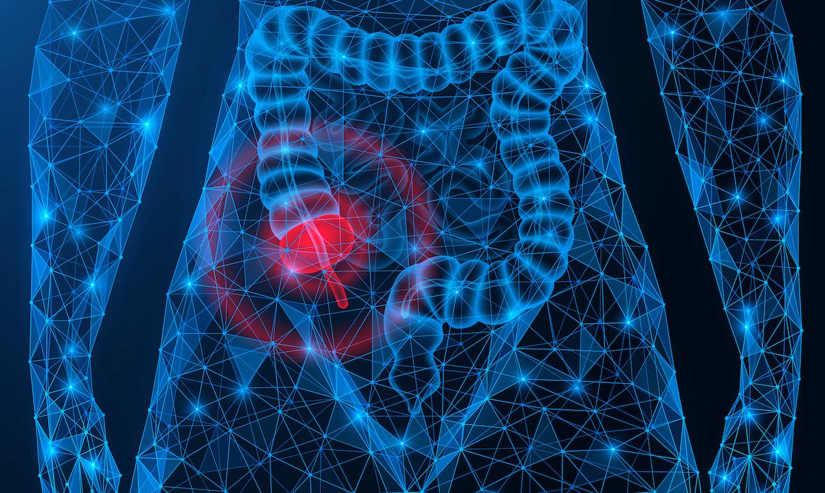 Rectocolite hémorragique, appendicectomie et risque de cancer colorectal : quel lien ?