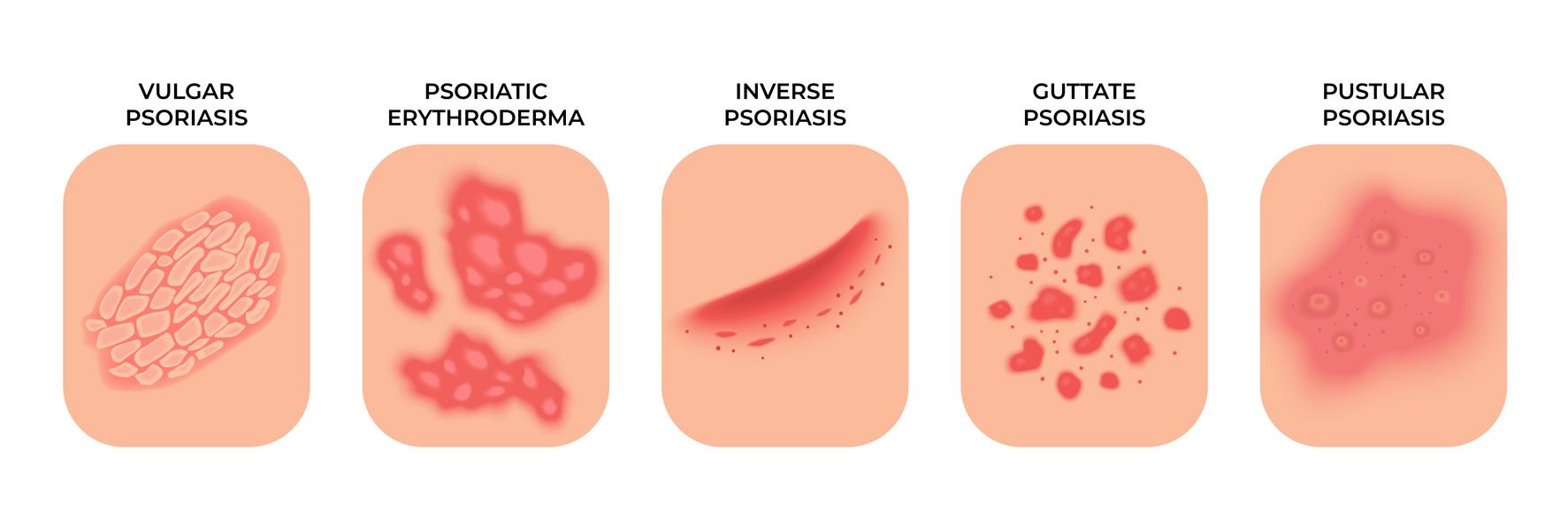 Psoriasis pustuleux généralisé : une première biothérapie efficace  