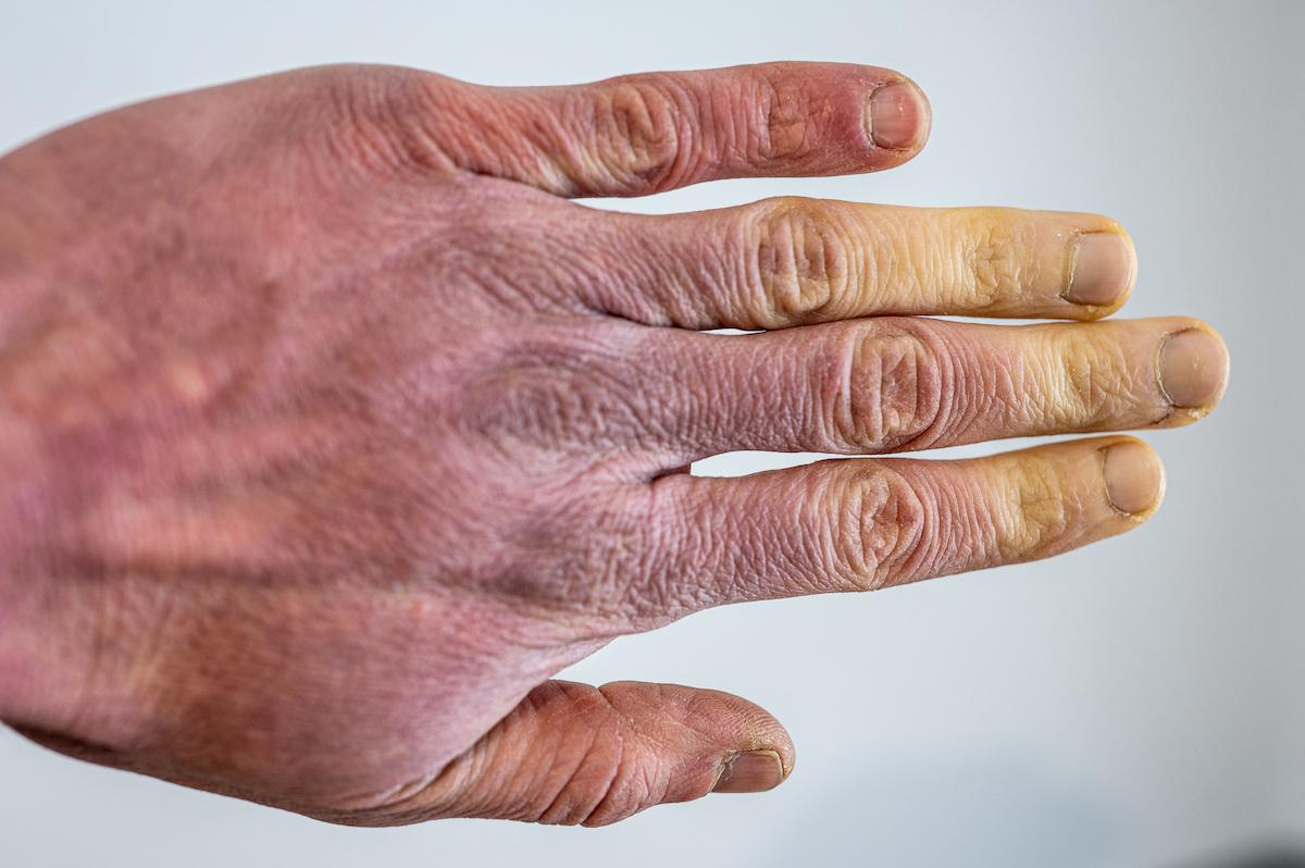 Syndrome de Raynaud : avancées du traitement en 2023