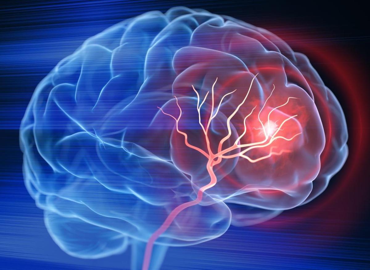 Gliome infiltrant du tronc cérébral : 1er cas mondial de guérison