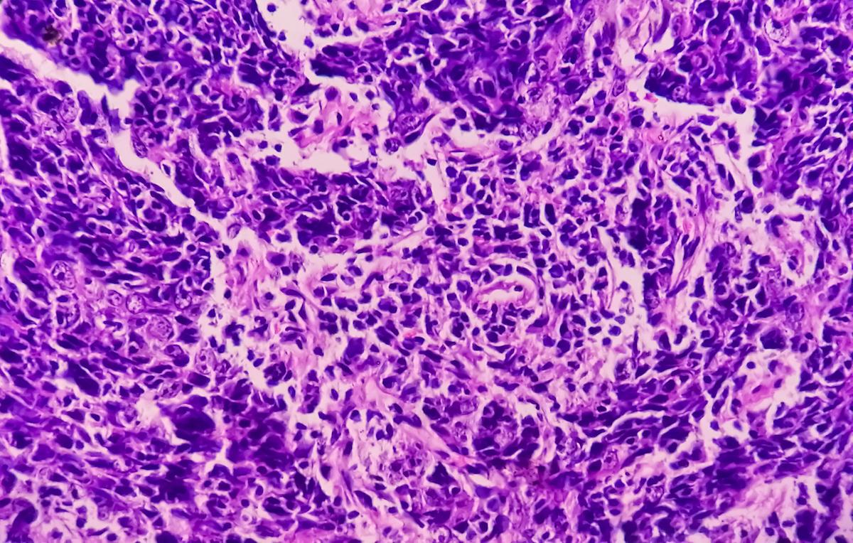 Carcinome naso-pharyngé récidivant ou métastasé : bénéfice de l’immunothérapie